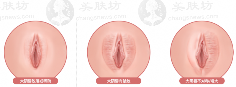 韩国如妍妇科医院PK韩国S女性医院！私密整形缩阴术宋成旭与李慧妍院长大对决！