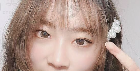 眼皮术后36天，我告别小眼睛，在重庆松山医院收获精致五官！ 