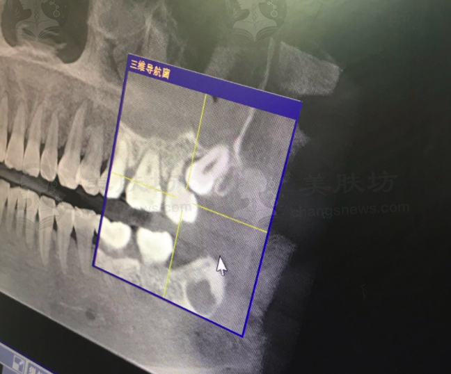 我在上海宏康医院拔牙超顺利，多年智齿困扰终于解决啦！ 