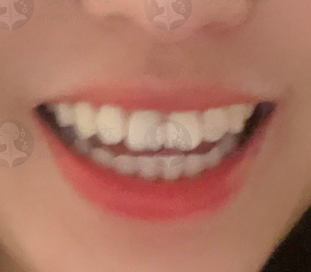 我多年牙齿外凸困扰，在北京禾禾口腔正畸后重获自信笑容！ 