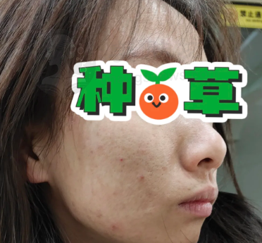 韩国露谭韩整形VS韩国BTN皮肤科！金祺泰与申聖湜院长激光祛痘疤痘印谁更强？ 