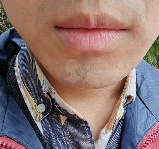 我用国产衡力 A 型肉毒素在贵阳利美康，轻松改善多年大小脸！ 