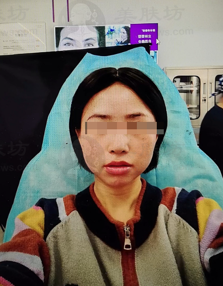 我被颈阔肌和咬肌问题困扰多年，衡力项目让我拥有少女线！ 