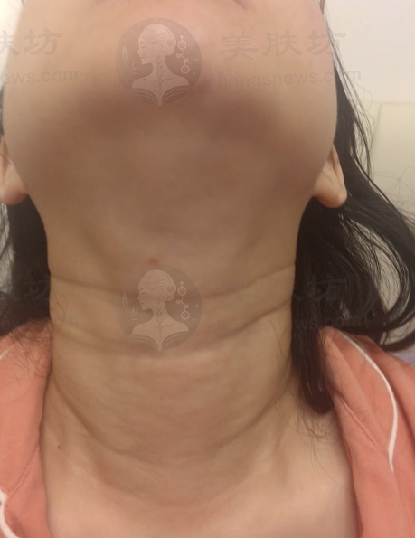 35岁的我天生颈纹超自卑，利美康让我重燃淡化颈纹希望！ 