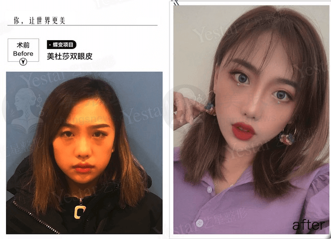 西安艺星付麟凤做皮肤综合管理怎么样？激光联合微针抗衰，268例真实反馈斑点淡化+下颌线提升，2026价格参考